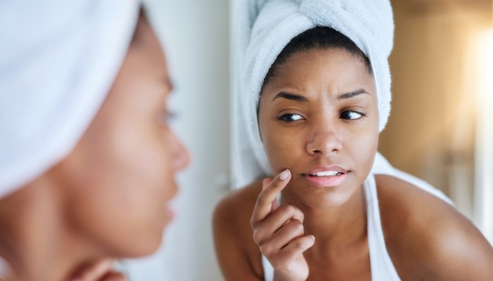 These Spots Are Often Confused For Hyperpigmentation, But Here’s What It Really Is